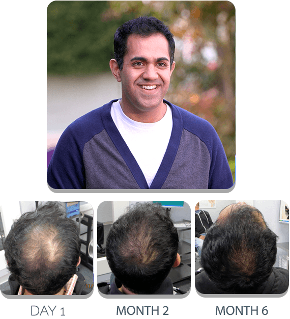 perdita di capelli perdita scalpmed metodo efficace prima dopo la ricrescita acquistare qui